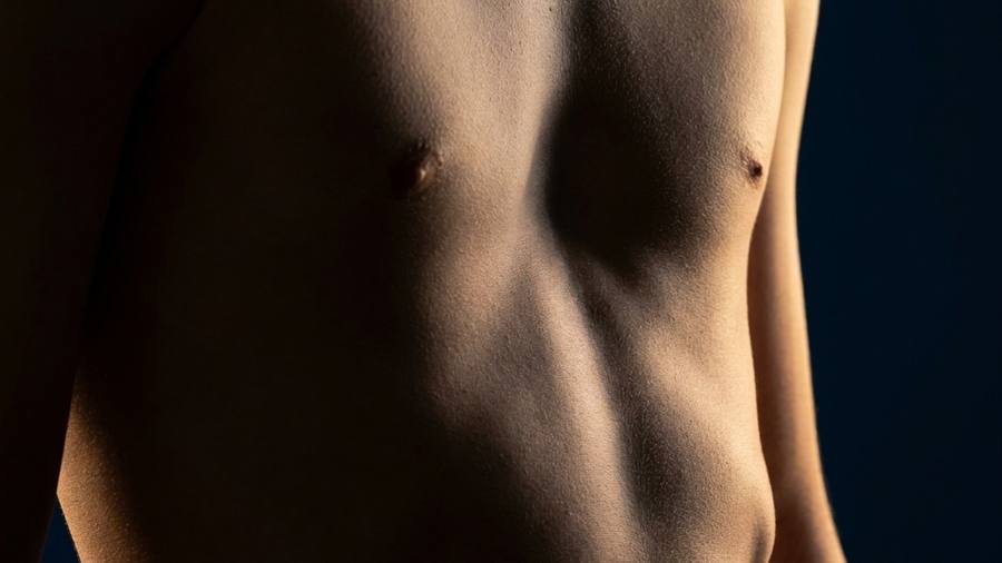 Pectus excavatum Nuss procedure thumbnail